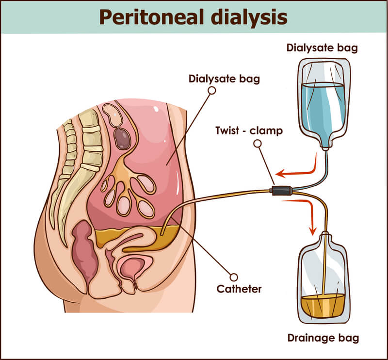 Peritoneal Dialysis Treatment at ARC Dialysis